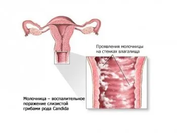 Як приймати флуконазол