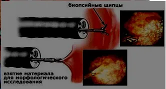 Все, що необхідно знати про колоноскопії - медичний центр прімамед (колоноскопії) Все, що необхідно знати про колоноскопії - медичний центр прімамед