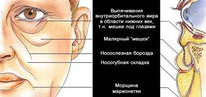 Як прибрати малярні мішки на вилицях під очима