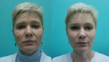 Як прибрати малярні мішки на вилицях під очима