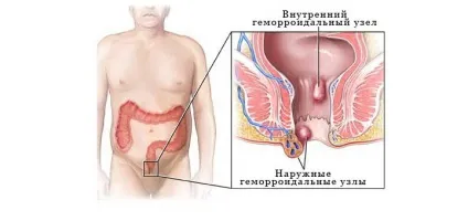 Як жити з гемороєм, причини і спосіб життя сприяє гемороєм - depils блог (сприяє) Як жити з гемороєм, причини і спосіб життя сприяє гемороєм - depils блог