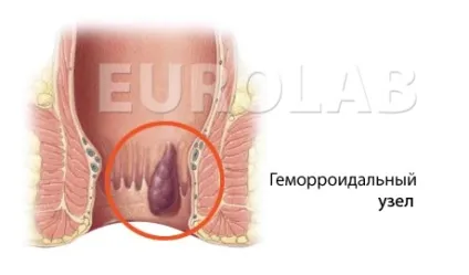 Як жити з гемороєм - медичний портал eurolab 1 (гемороєм) Як жити з гемороєм - медичний портал eurolab 1