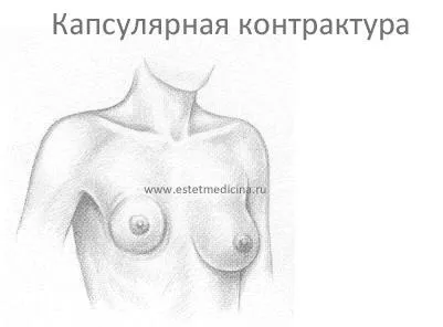 капсулярна контрактура