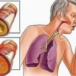 Кашель вечорами у дорослого причини чому посилюється до ночі (кашель) Кашель вечорами у дорослого причини чому посилюється до ночі
