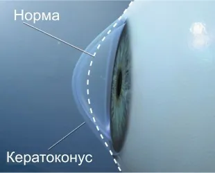 Кератоконус лікування, симптоми, стадії (лікування) Кератоконус лікування, симптоми, стадії