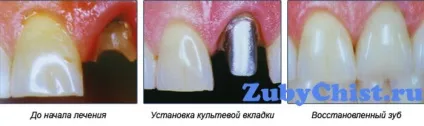 Керамічна вкладка замість пломби це повинен знати кожен (перед установкою вкладки) Керамічна вкладка замість пломби це повинен знати кожен