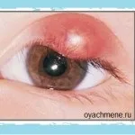 Ячмінь на оці, фото
