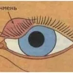 Ячмінь на оці, фото
