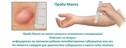 Навіщо роблять пробу манту, що робити, якщо є позитивна реакція (роблять Манту дітям) Навіщо роблять пробу манту, що робити, якщо є позитивна реакція