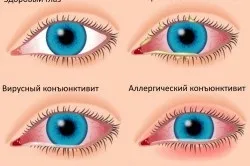 кон'юнктивальний мішок