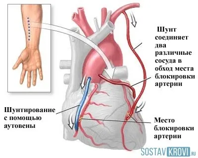 Коронарне шунтування судин серця підготовка, операція, реабілітація, відгуки і ціна (серця) Коронарне шунтування судин серця підготовка, операція, реабілітація, відгуки і ціна