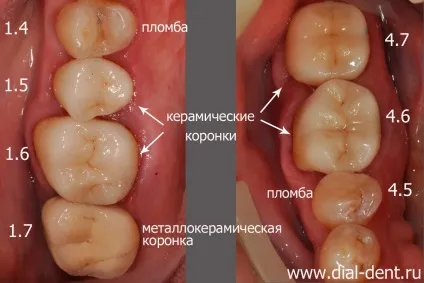 Комплексне лікування зубів (протезування зубів) Комплексне лікування зубів