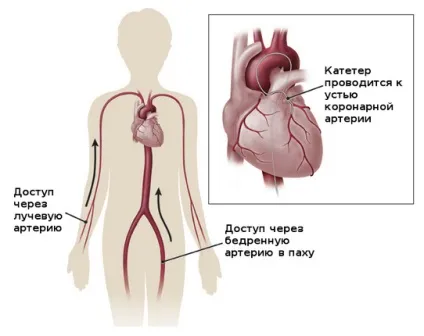коронарне стентування