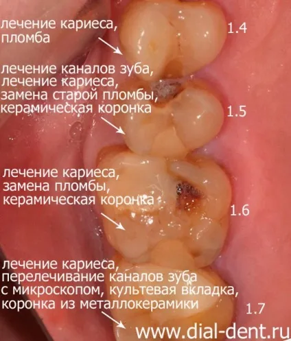 Комплексне лікування зубів (лікування карієсу зубів) Комплексне лікування зубів