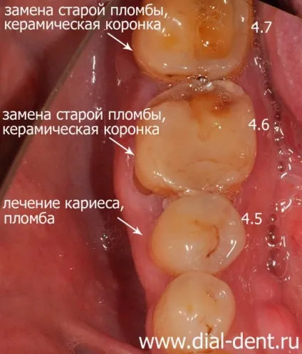 Комплексне лікування зубів (зубів) Комплексне лікування зубів