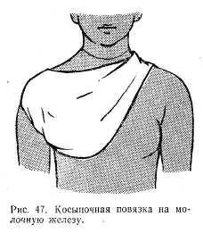 Косиночная пов'язка