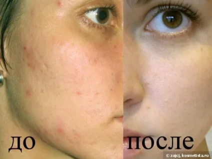 Косметичний багаж для проблемної шкіри відгуки (крем для обличчя) Косметичний багаж для проблемної шкіри відгуки