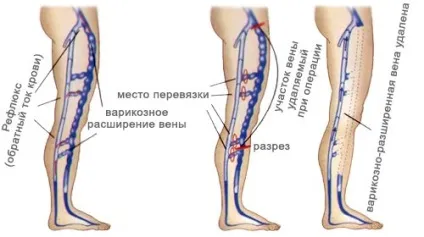 Кросектомія опис, хід операції, наслідки (правильно своєчасно проведеній) Кросектомія опис, хід операції, наслідки