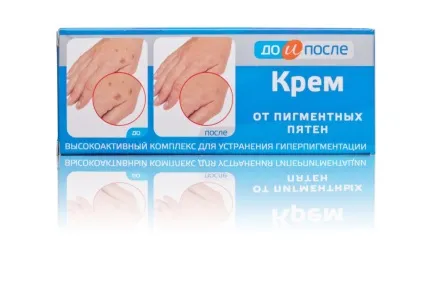 Крем «до і після» від пігментних плям склад, дія, показання (після) Крем «до і після» від пігментних плям склад, дія, показання