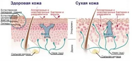 Ксероз симптоми, причини і рішення