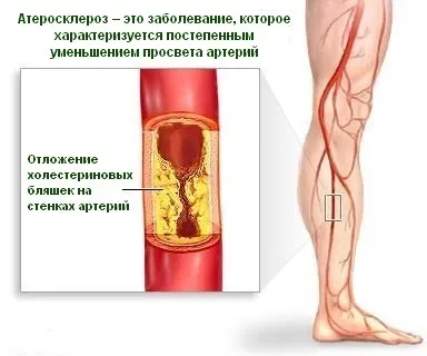 Лікування атеросклерозу медикаментозними препаратами (препаратами) Лікування атеросклерозу медикаментозними препаратами