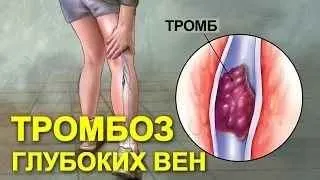 Лікування тромбозу за допомогою рецептів народної медицини (лікування) Лікування тромбозу за допомогою рецептів народної медицини