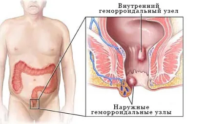 Лікування геморою при гв, причини виникнення захворювання (лікування) Лікування геморою при гв, причини виникнення захворювання