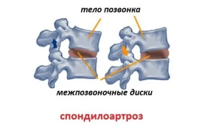 Лікування грудного спондилоартроз народними засобами (народними) Лікування грудного спондилоартроз народними засобами