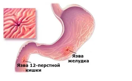 Лікування виразки дванадцятипалої кишки народними засобами трави