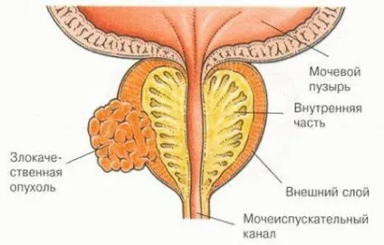 Лікування хронічного простатиту всі способи і методи (простатиту) Лікування хронічного простатиту всі способи і методи