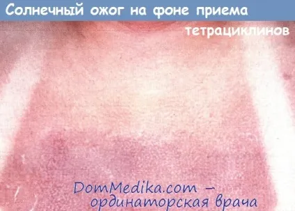 Лікарська фоточутливість і фотосенсибілізація (лікарська фоточутливість) Лікарська фоточутливість і фотосенсибілізація