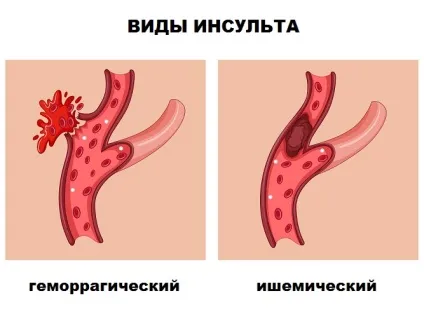 Лікування інсульту в германии (клітин головного мозку) Лікування інсульту в германии
