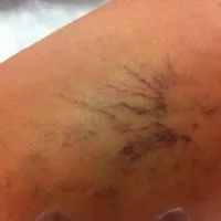 Лопаються судини на ногах - причини і способи лікування (судини) Лопаються судини на ногах - причини і способи лікування
