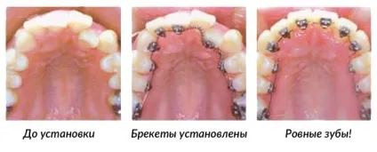 Лінгвальні брекети установка з внутрішньої сторони зубів (сторони) Лінгвальні брекети установка з внутрішньої сторони зубів