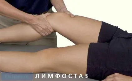 Лимфедема причини появи, симптоми і лікування (лімфедема) Лимфедема причини появи, симптоми і лікування