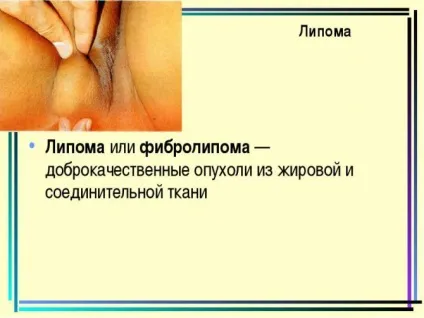 Ліпома на статевих губах в паху у жінки (губах) Ліпома на статевих губах в паху у жінки