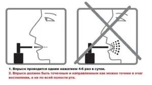 Люголь при ангіні розчин і спрей, чи допомагає (розчин) Люголь при ангіні розчин і спрей, чи допомагає