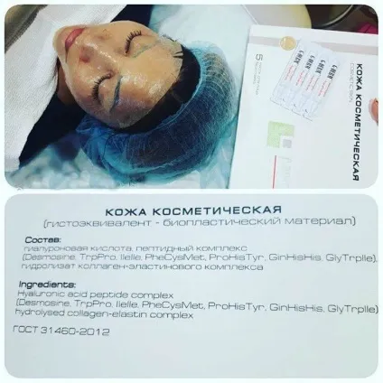 Мануальне ремоделирование матриксу на основі біокожі «g-derm professional» (основі) Мануальне ремоделирование матриксу на основі біокожі «g-derm professional»
