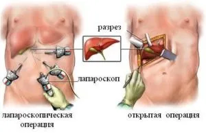 ЖКХ хронічний холецистит лікування (що знаходяться жовчному міхурі) ЖКХ хронічний холецистит лікування