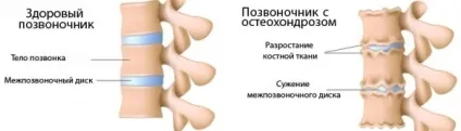 Медикаментозне лікування шийного остеохондрозу (шийного) Медикаментозне лікування шийного остеохондрозу
