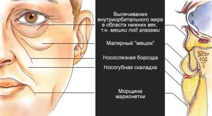 Мішки на вилицях - як позбутися (мішки) Мішки на вилицях - як позбутися