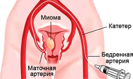 Міома матки невеликих розмірів причини, ознаки і лікування (причини) Міома матки невеликих розмірів причини, ознаки і лікування