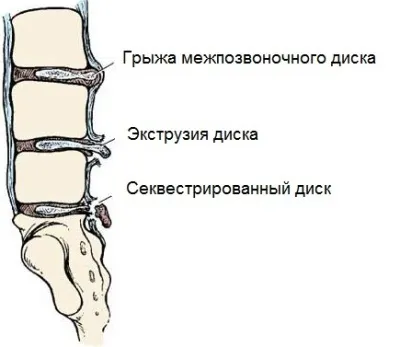 Чи можна вилікувати секвеструвати грижу хребта (можна) Чи можна вилікувати секвеструвати грижу хребта