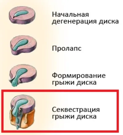 Чи можна вилікувати секвеструвати грижу хребта (грижу) Чи можна вилікувати секвеструвати грижу хребта