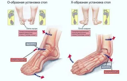 Чи можна бігати при плоскостопості, школа бігу run studio (бігу) Чи можна бігати при плоскостопості, школа бігу run studio
