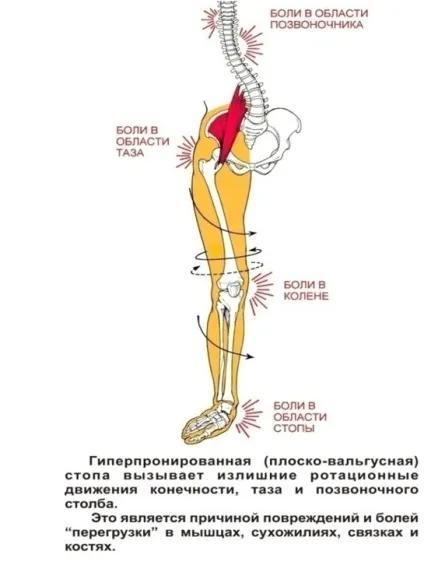 Чи можна бігати з плоскостопістю, марафонець (бігати) Чи можна бігати з плоскостопістю, марафонець