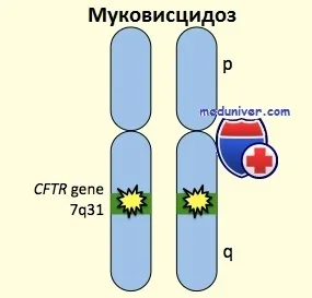 Муковісцидоз у дітей причини, клініка, діагностика (муковісцидоз) Муковісцидоз у дітей причини, клініка, діагностика