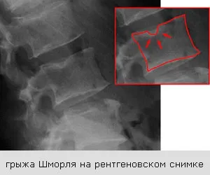 Чи треба лікувати грижу Шморля і як - симптоми і лікування грижі Шморля (грижа Шморля лікування) Чи треба лікувати грижу Шморля і як - симптоми і лікування грижі Шморля