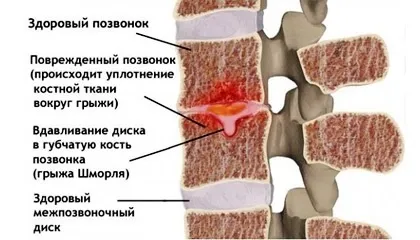 Чи треба лікувати грижу Шморля і як - симптоми і лікування грижі Шморля (симптоми) Чи треба лікувати грижу Шморля і як - симптоми і лікування грижі Шморля