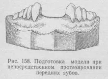 Безпосереднє протезування при частковій втраті зубів, ортопедична стоматологія (безпосереднє) Безпосереднє протезування при частковій втраті зубів, ортопедична стоматологія